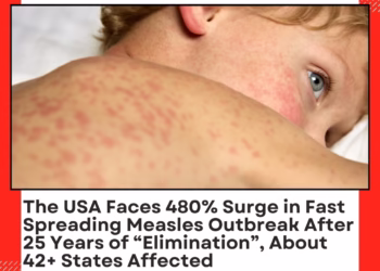 The USA Faces 480% Surge in Fast Spreading Measles Outbreak After 25 Years of “Elimination”, About 42+ States Affected